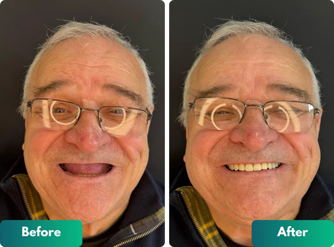 cost full mouth implants