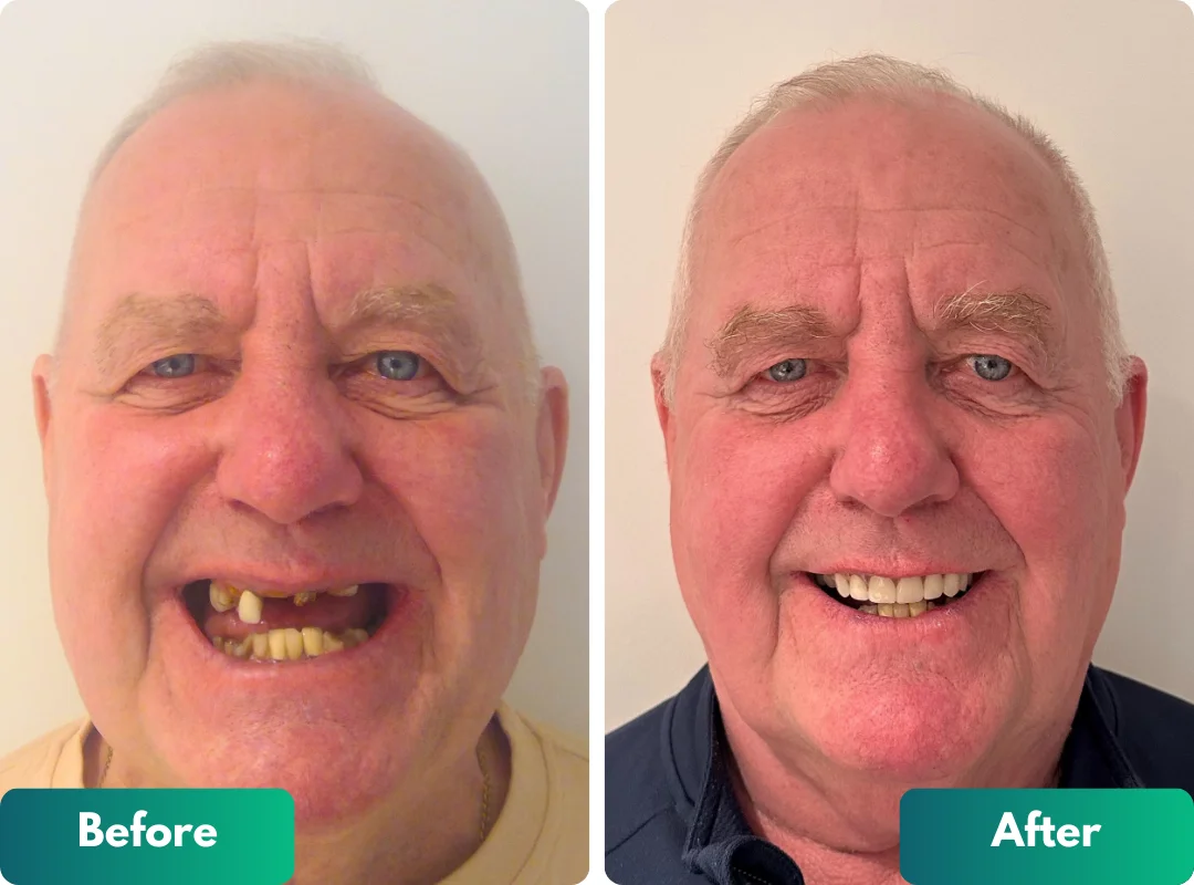 cheap full mouth implants