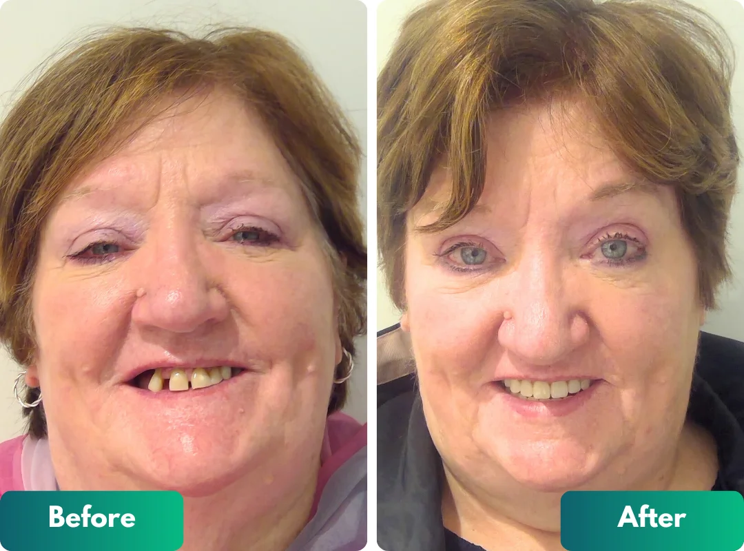 full mouth dental implants