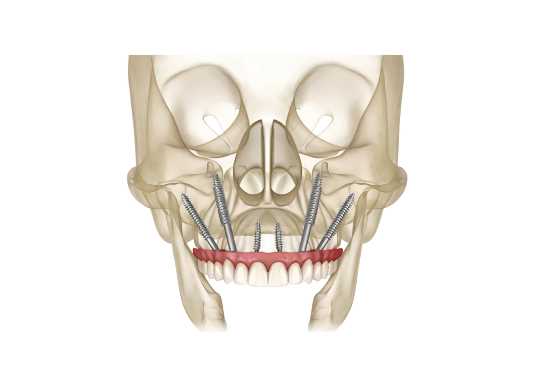 Zygomatic dental implants 