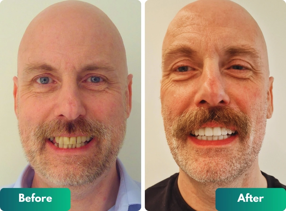 Full arch dental implants