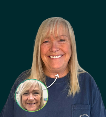 Full Jaw Implants