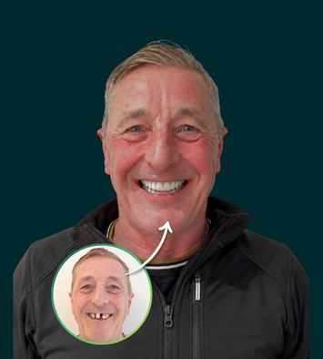 Before and after full mouth dental implants — failing upper teeth replaced with a fixed bridge