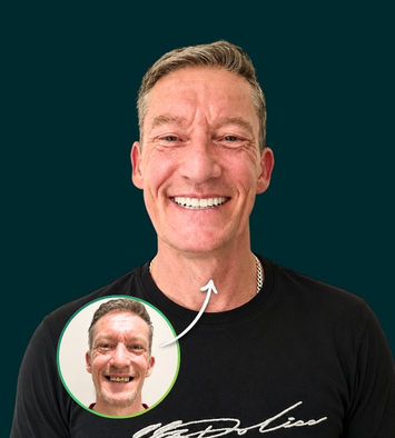 Patient before and after All-on-4 dental implant treatment at Implantly