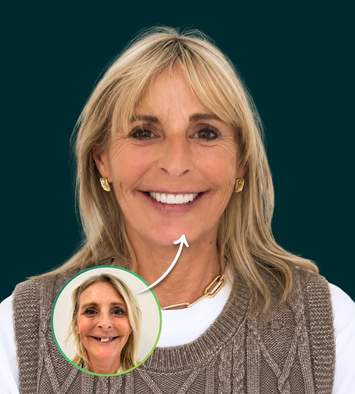 Before and after full jaw dental implants replacing missing and worn teeth