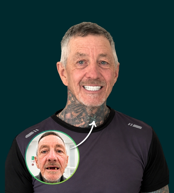 Smile transformation with a fixed full arch implant bridge, before and after
