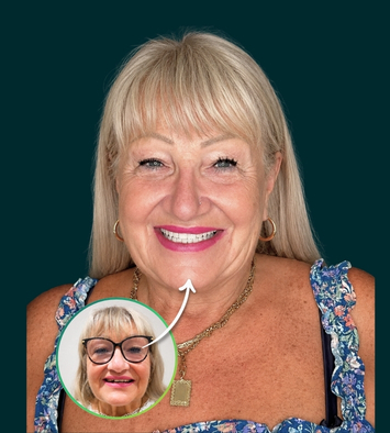 Before and after implant treatment for advanced tooth loss