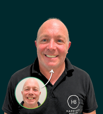 Full arch dental implant restoration, before and after treatment