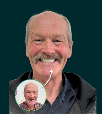 Before and after zirconia full arch implant bridge