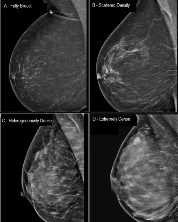 Four mammogram images showing breast density categories labeled A to D: A-Fatty Breast, B-Scattered Density, C-Heterogeneously Dense, D-Extremely Dense.