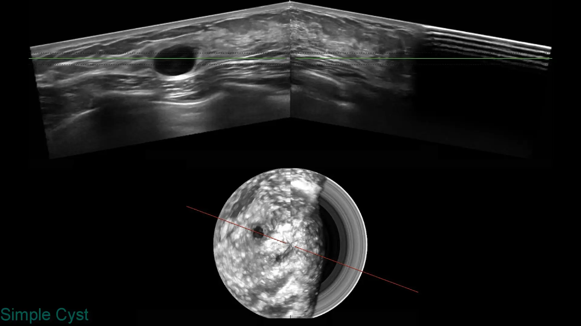 Medical ultrasound image showing a simple cyst as a dark circular area within tissue.