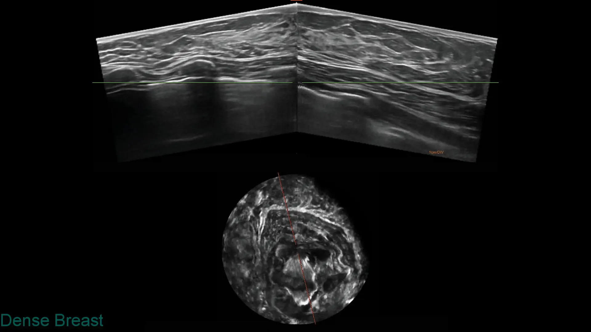 Ultrasound images showing dense breast tissue with layered fibrous structures and a circular cross-sectional view with measuring line.