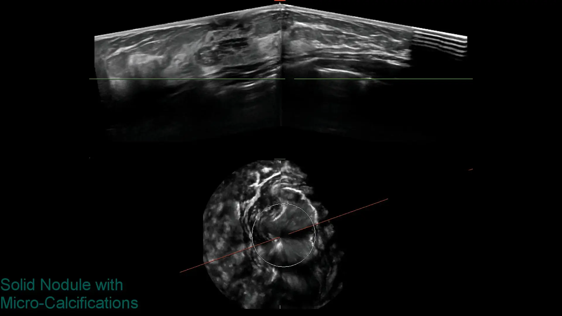 Ultrasound images showing a solid nodule with micro-calcifications marked within the tissue.