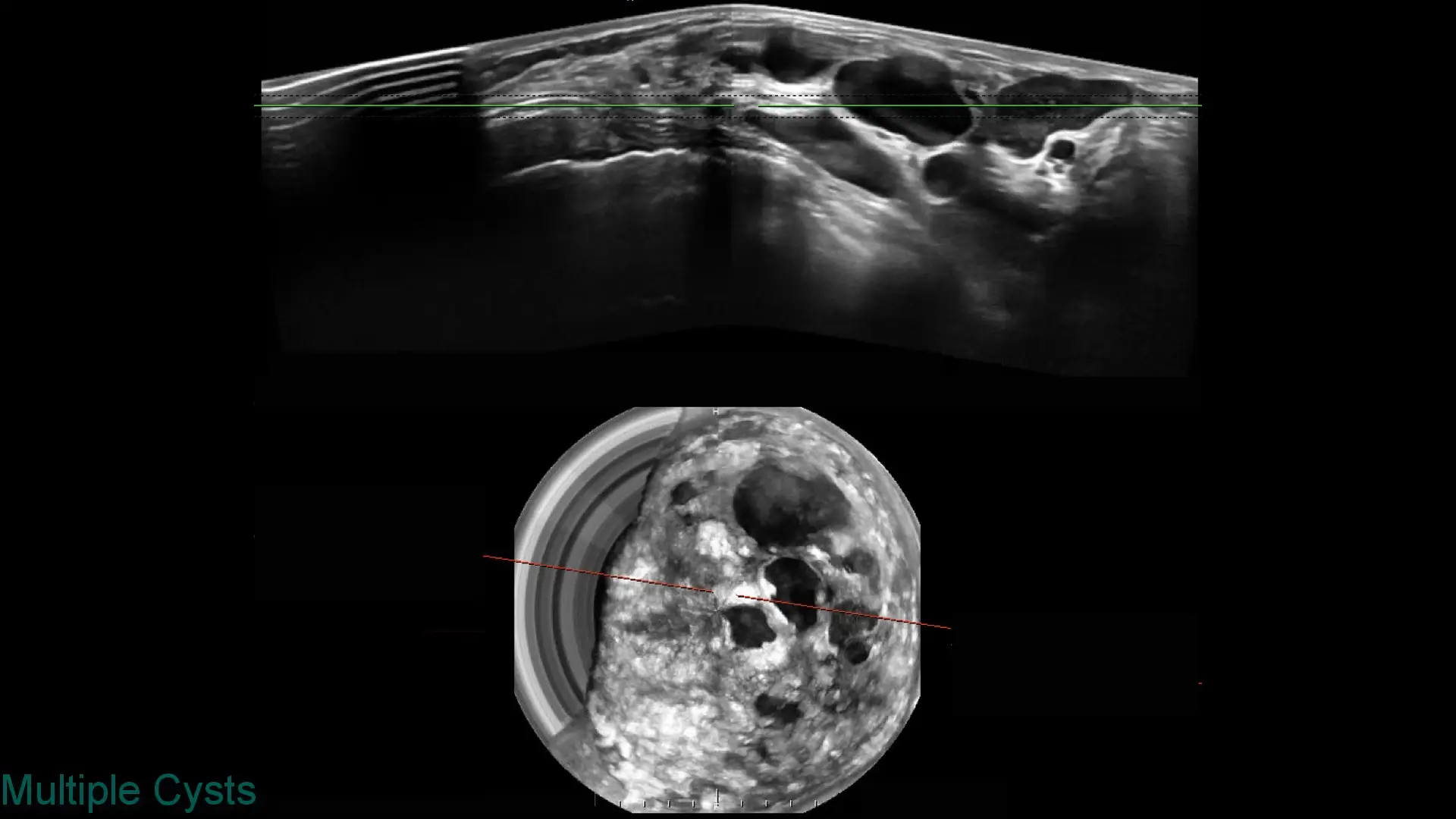 Ultrasound images showing multiple cysts as dark fluid-filled spaces within tissue.