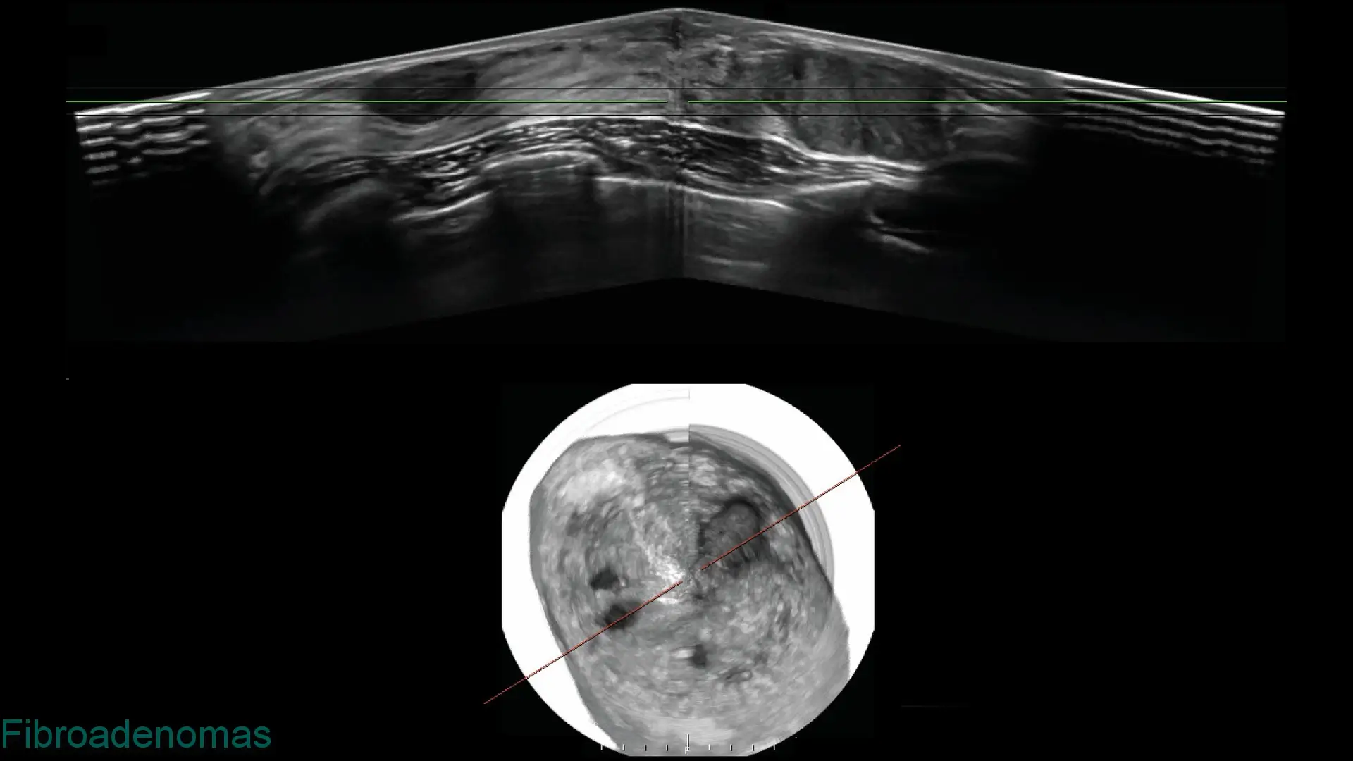 Ultrasound and cross-sectional imaging showing breast fibroadenomas with distinct masses in tissue.