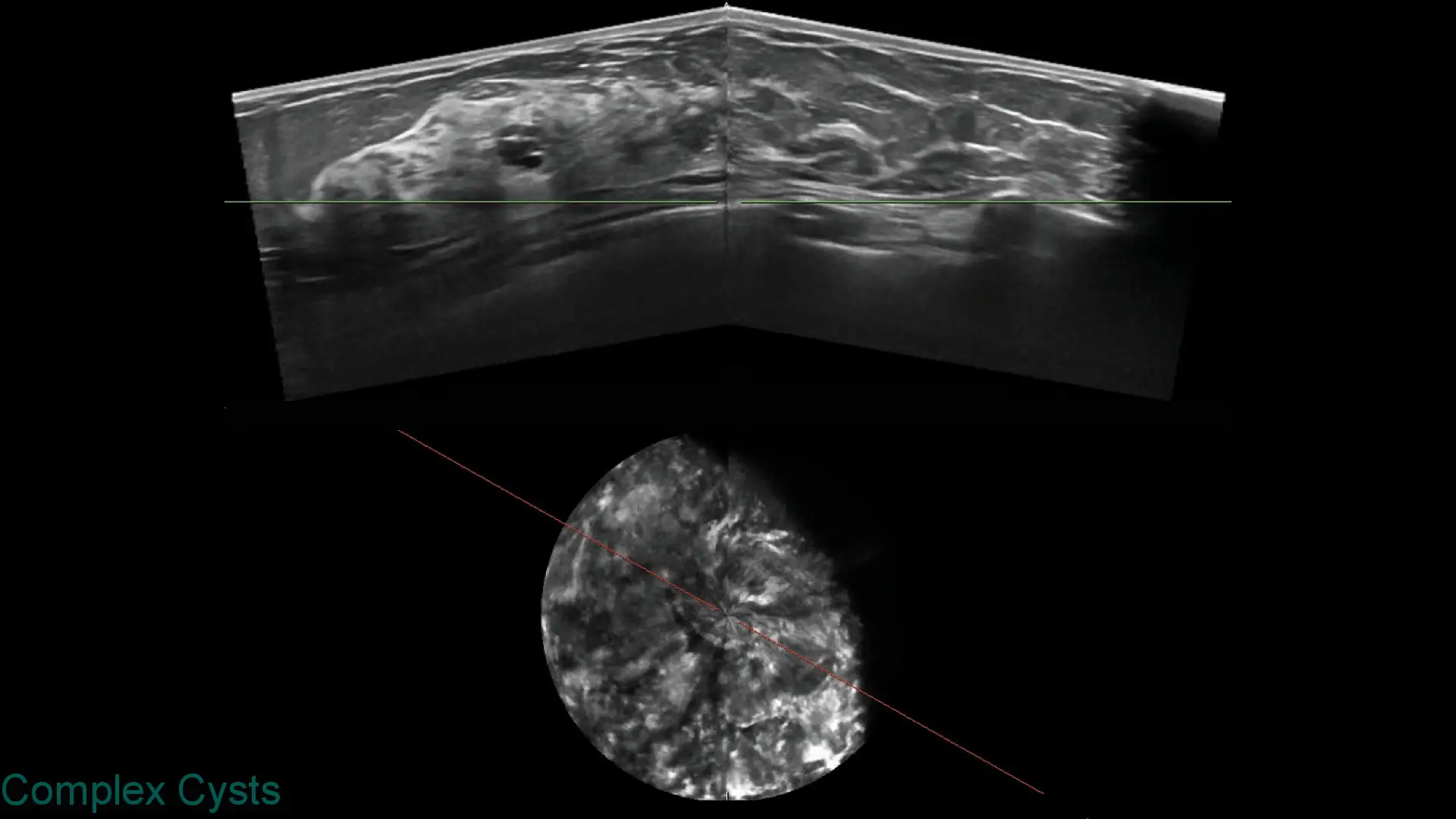 Ultrasound image showing complex cyst structures with layered tissue patterns and a circular scan area.