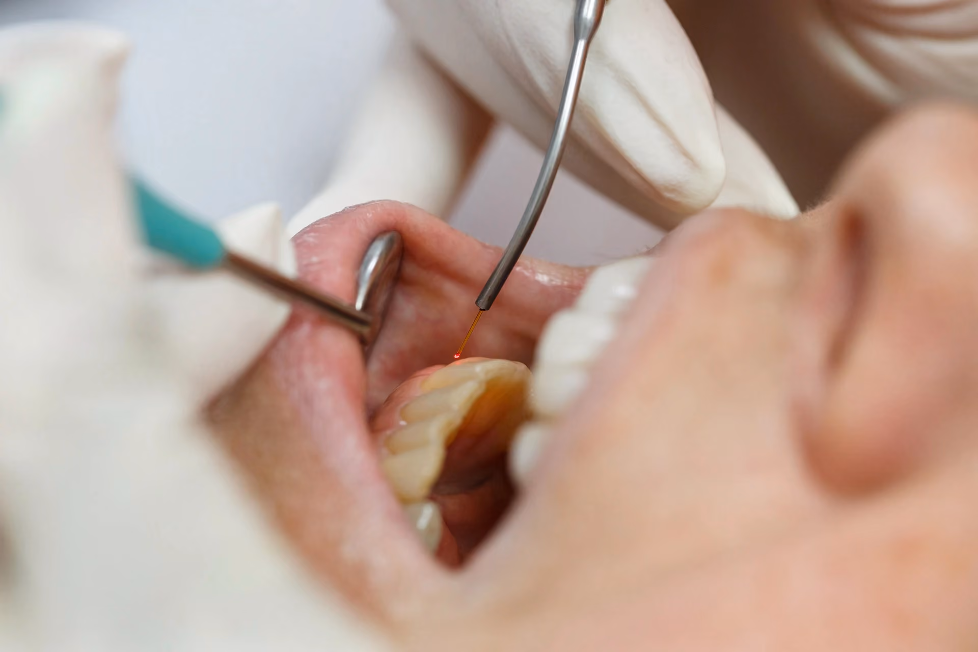 Soft-Tissue Laser Therapy in Murfreesboro