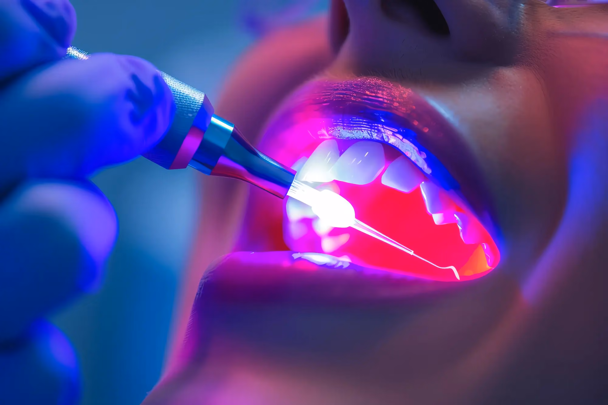 Dental Laser Therapy in Murfreesboro
