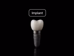 Single and full mouth dental implants at CSmile Bali