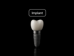 Single and full mouth dental implants at CSmile Bali