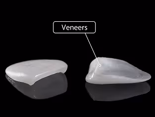 Patient receiving veneers for smile improvement