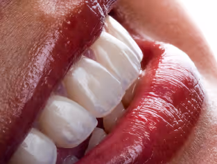 Cosmetic Hollywood smile procedure