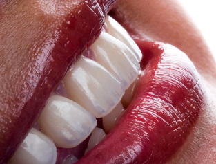 Cosmetic Hollywood smile procedure