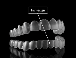 Invisalign clear aligners for teeth straightening