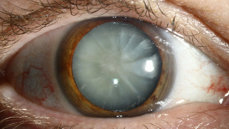Advanced cataract — clouded eye lens shown in clinical photograph at Stratus Eye in Suwanee, GA