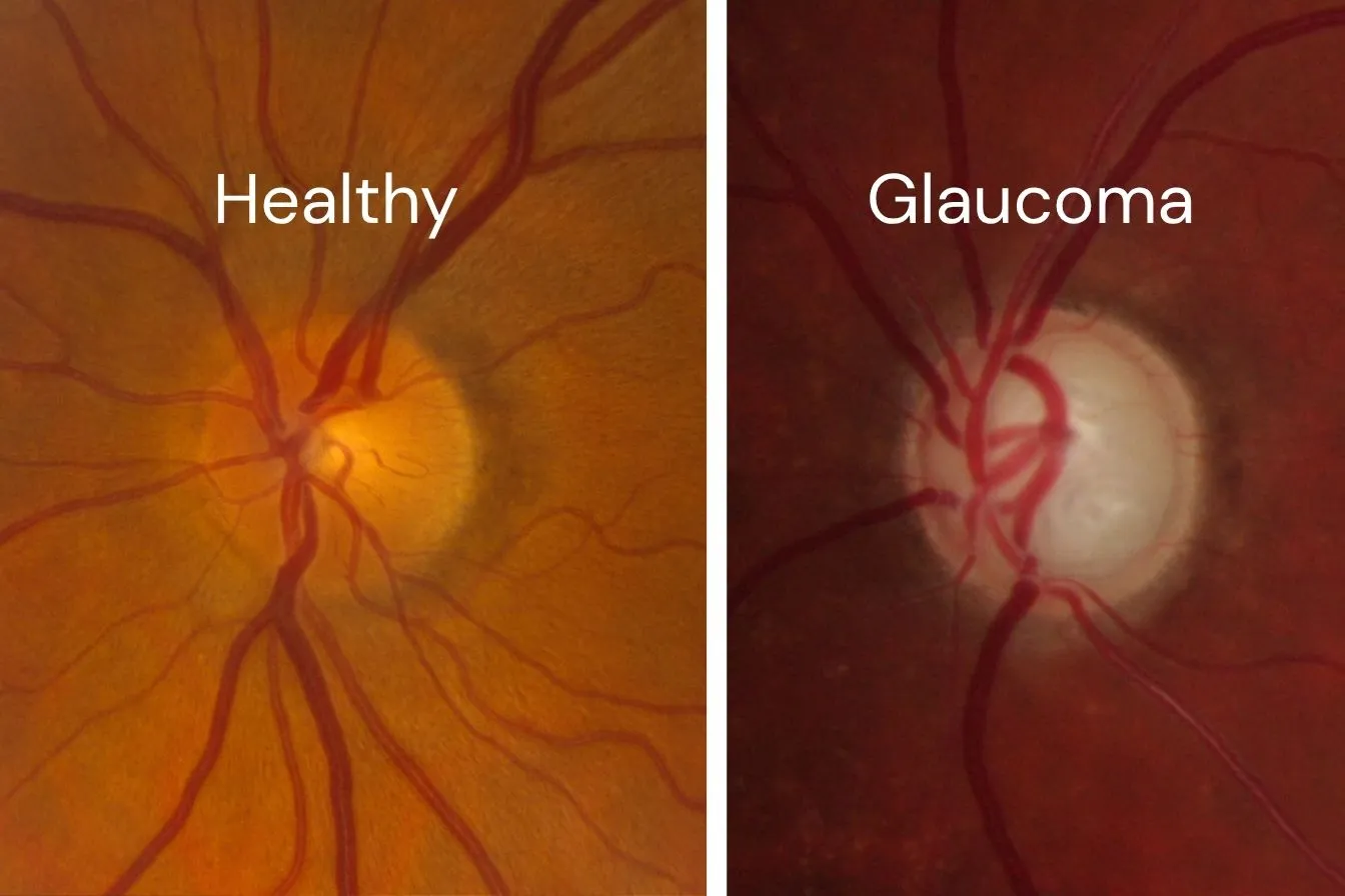 Healthy optic nerve versus glaucoma-damaged optic nerve — glaucoma detection at Stratus Eye in Suwanee, GA