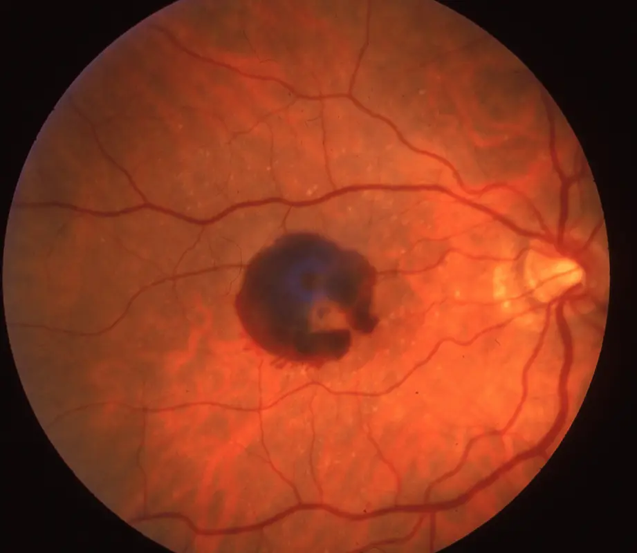 Wet age-related macular degeneration — retinal photograph showing advanced macular damage at Stratus Eye in Suwanee, GA