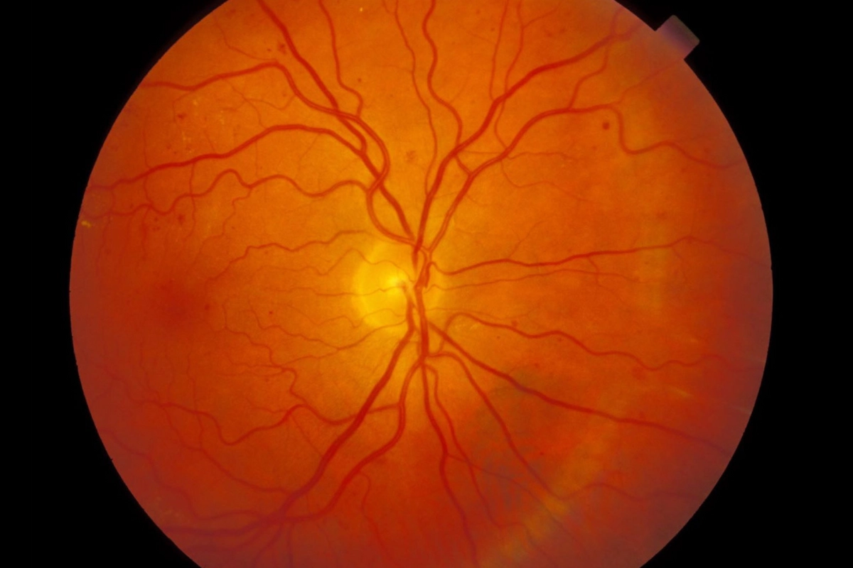 Mild nonproliferative diabetic retinopathy — retinal photograph showing early stage changes at Stratus Eye in Suwanee, GA