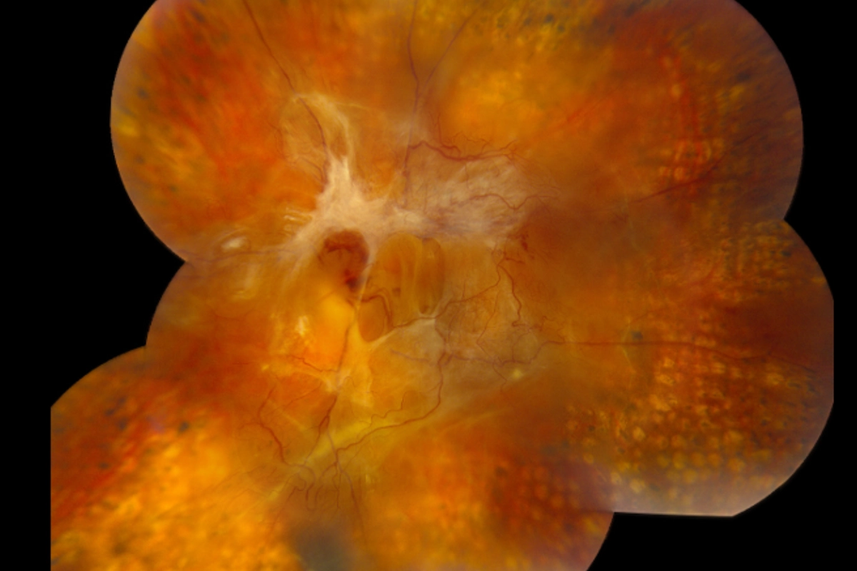 roliferative diabetic retinopathy — advanced stage retinal photograph at Stratus Eye in Suwanee, GA