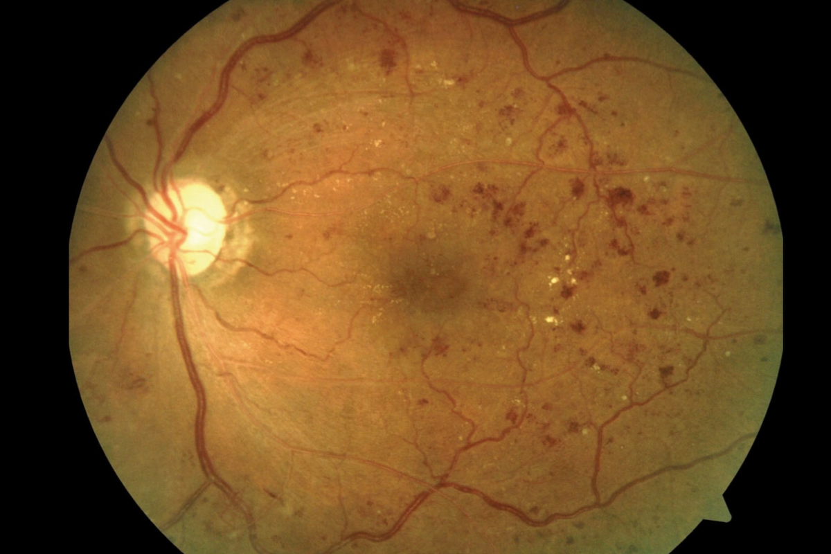 Moderate to severe nonproliferative diabetic retinopathy — retinal photograph showing disease progression at Stratus Eye in Suwanee, GA