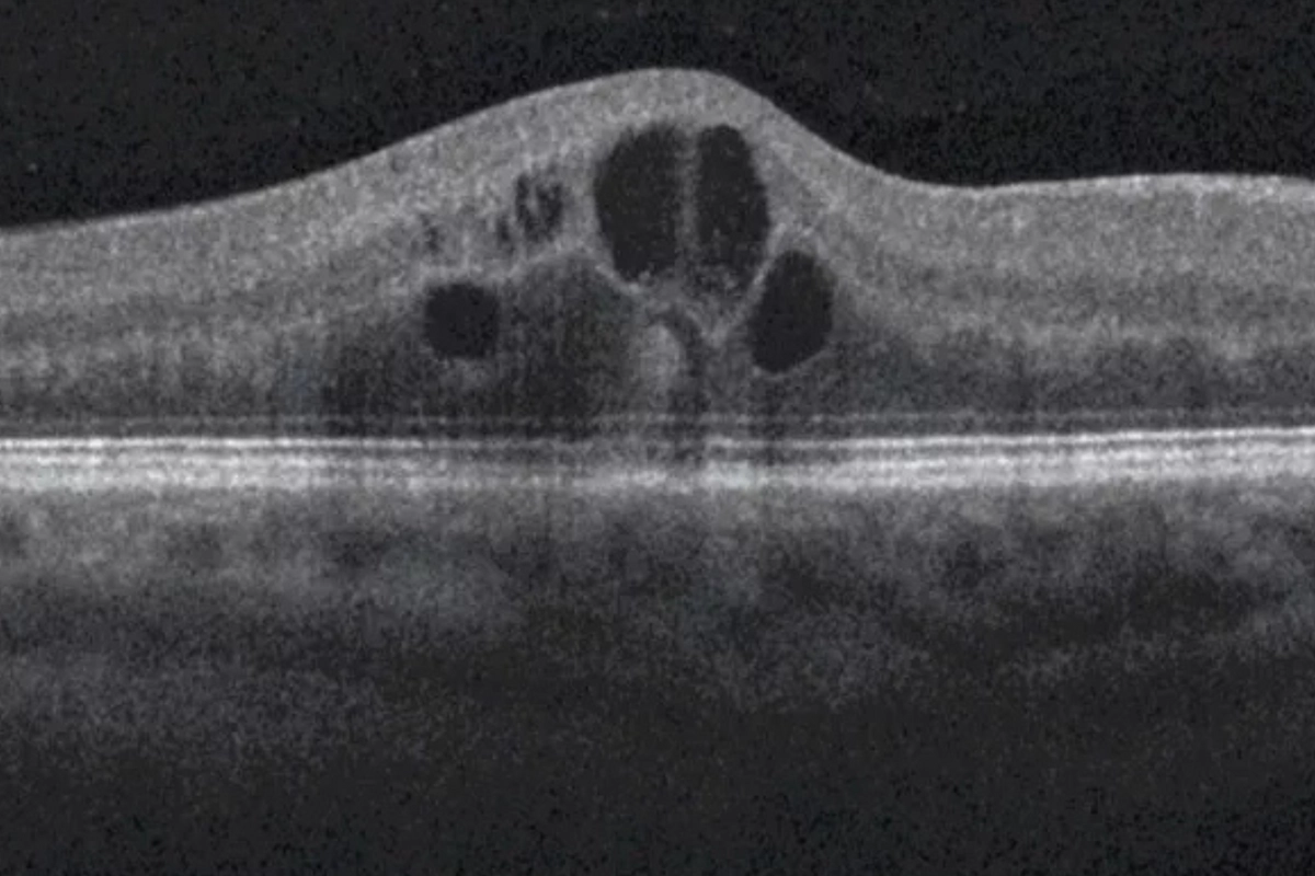OCT scan showing diabetic macular edema — fluid accumulation in the macula at Stratus Eye in Suwanee, GA