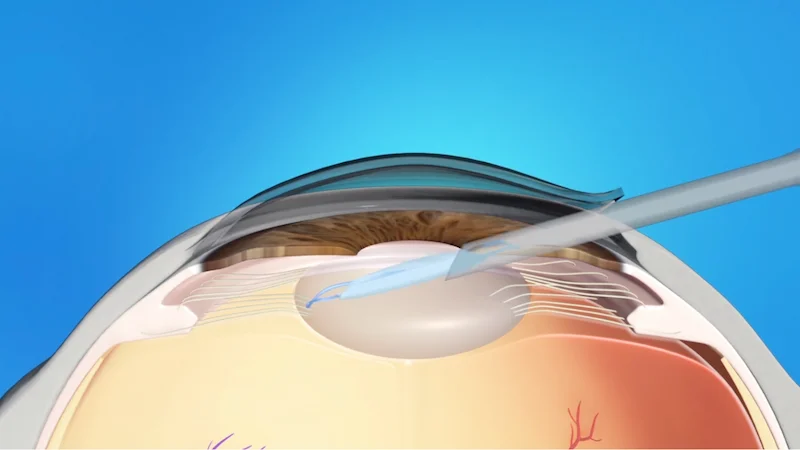 insertion of lens implant for cataract surgery at Stratus Eye in Suwanee, GA