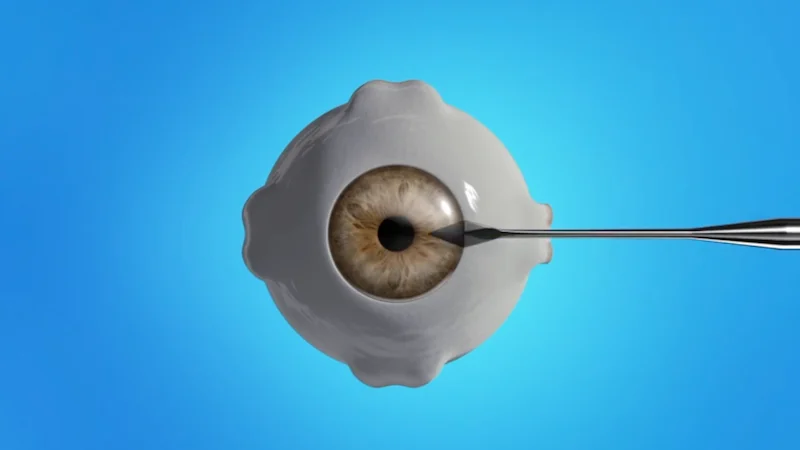 incision step during cataract surgery at Stratus Eye in Suwanee, GA