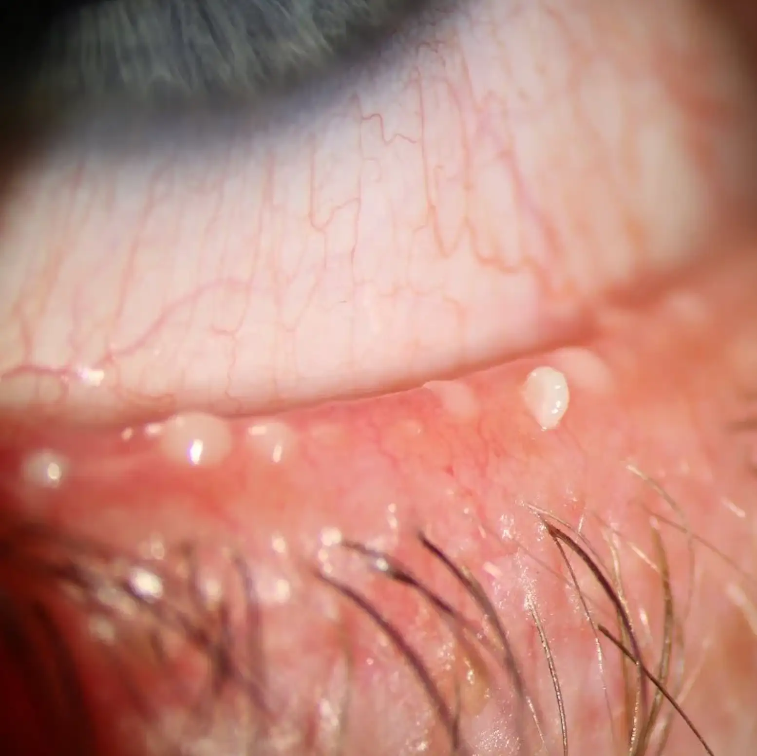 Meibomian gland dysfunction with blocked gland openings along the eyelid margin — evaluated at Stratus Eye in Suwanee, GA