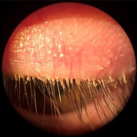 Demodex collarettes at the base of the eyelashes — a clinical sign of demodex blepharitis evaluated at Stratus Eye in Suwanee, GA