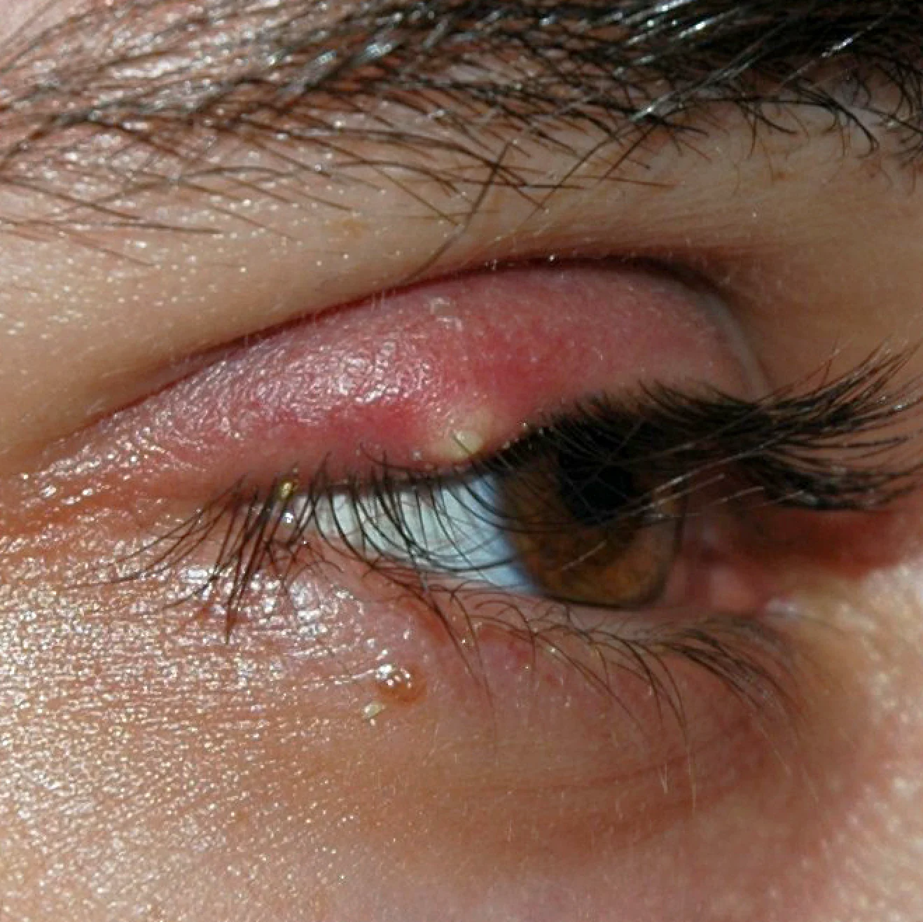 Clinical stye on the upper eyelid — acute meibomian gland infection treated at Stratus Eye in Suwanee, GA