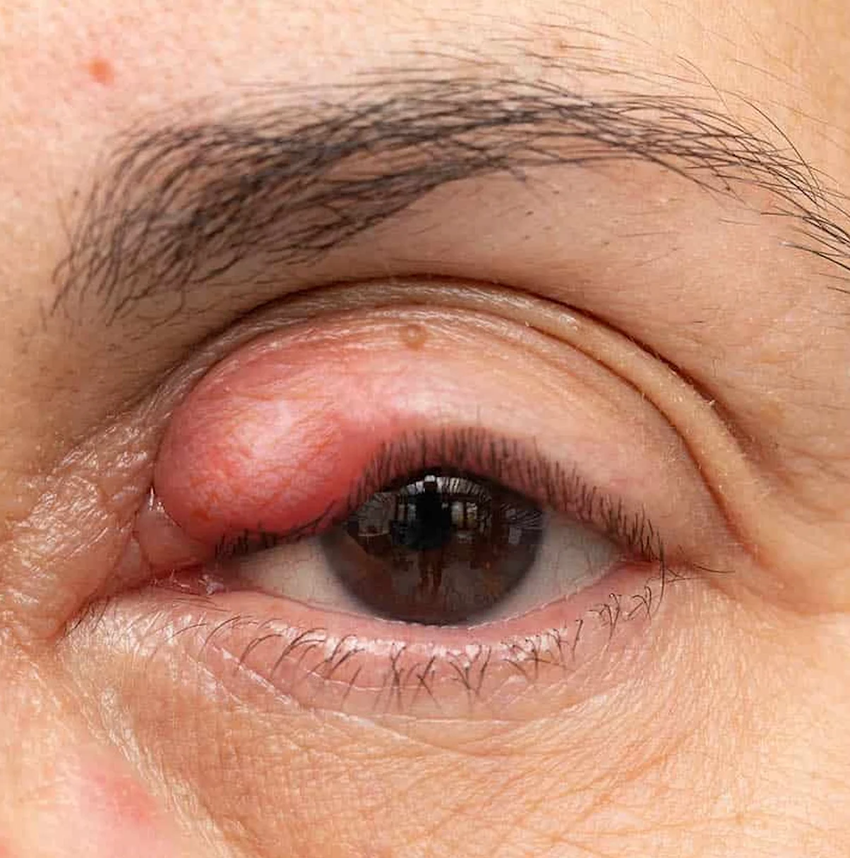 Chalazion on the upper eyelid — firm painless eyelid lump from a blocked meibomian gland treated at Stratus Eye in Suwanee, GA