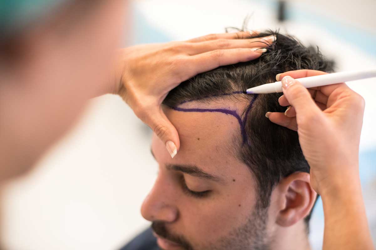 En man får sin nya hårlinje ritad