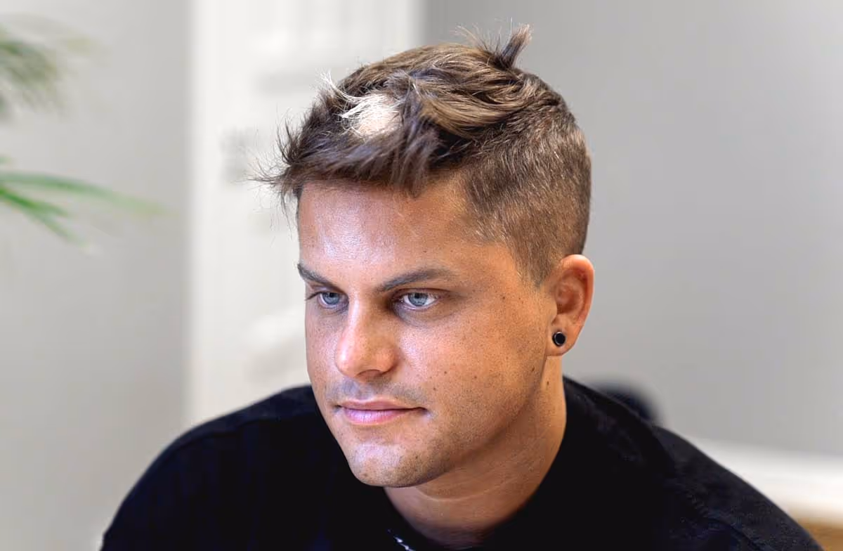En man med Alopecia areata