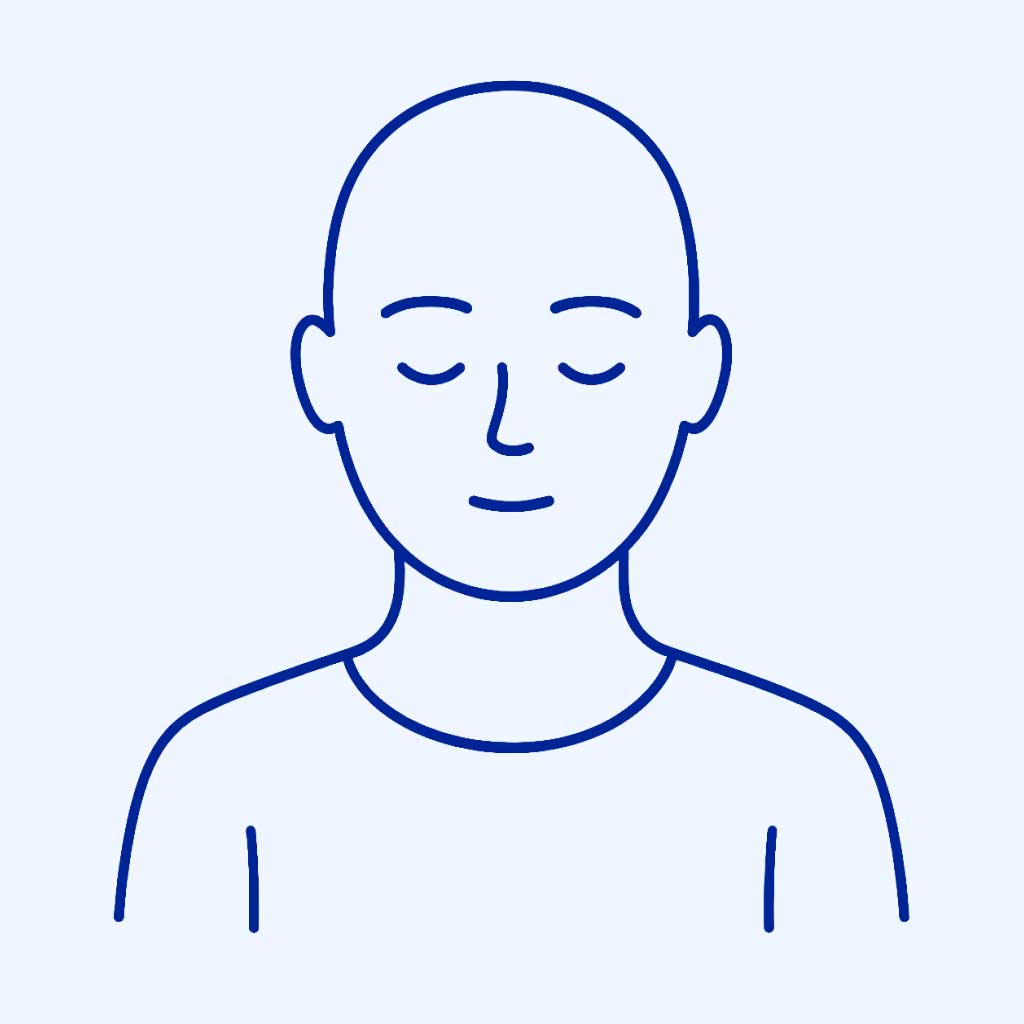 En illustration över alopecia totalis