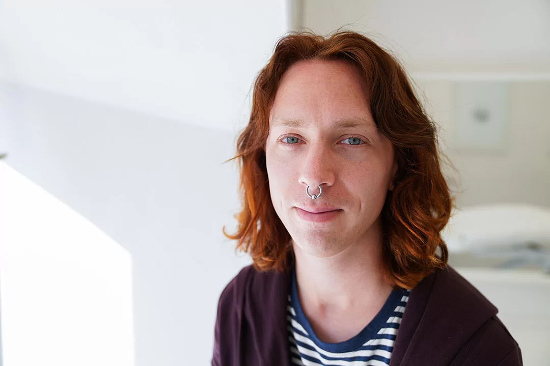 Quinn efter sin hårtransplantation