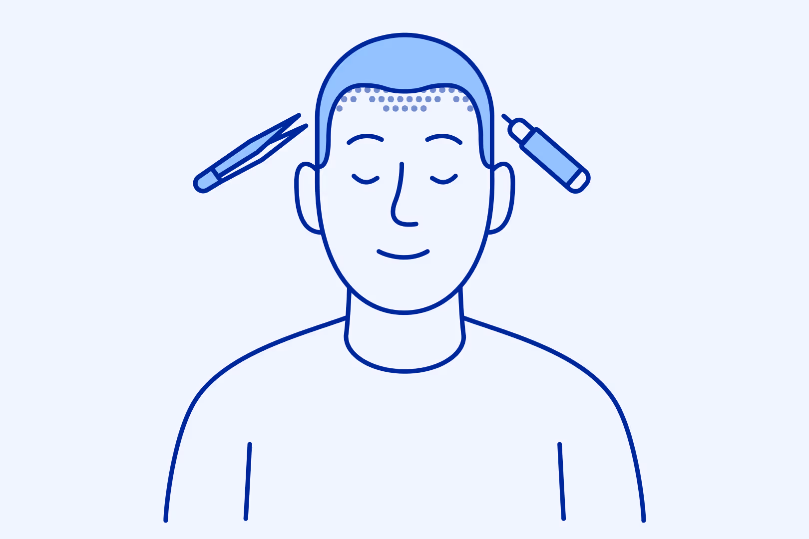 Illustration över FUE metoden