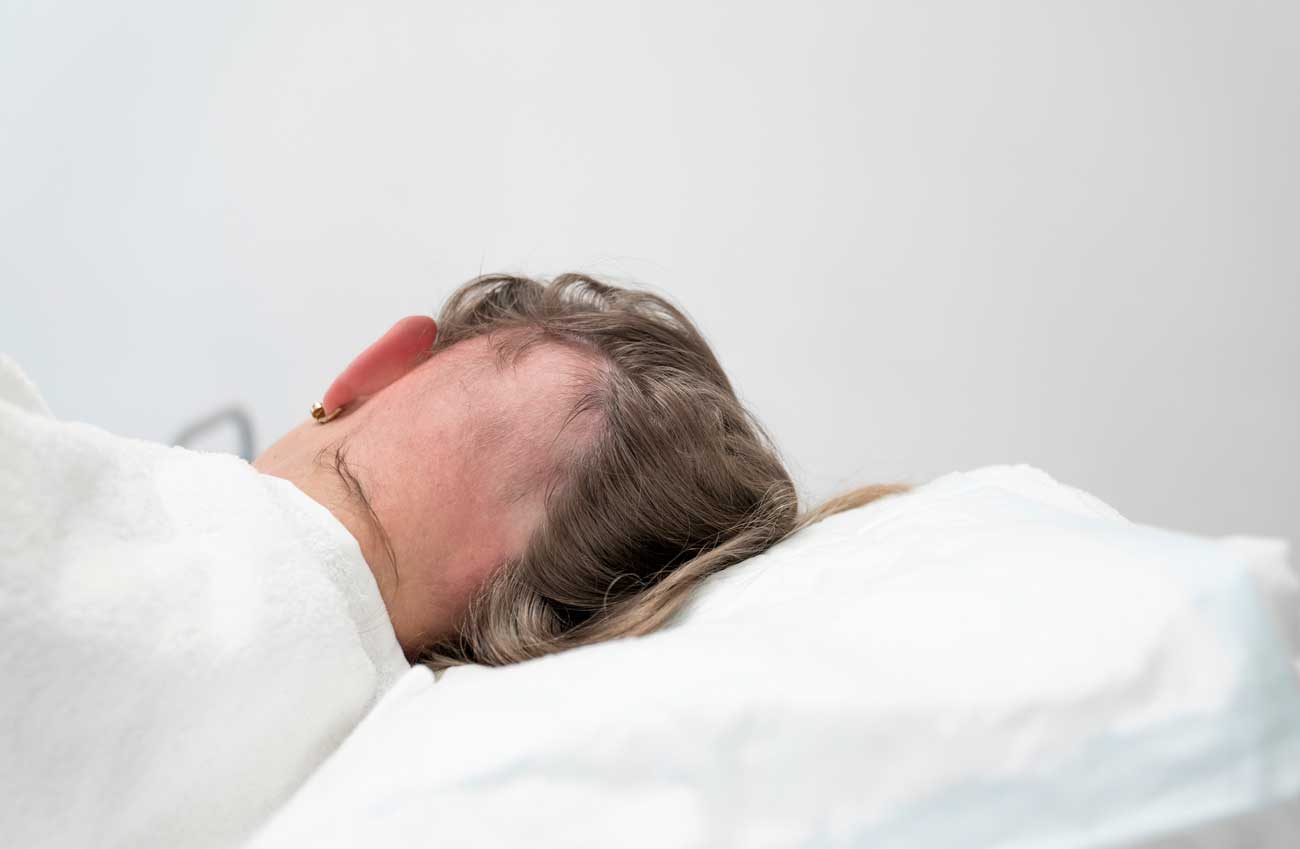 En kvinna med Alopecia totalis