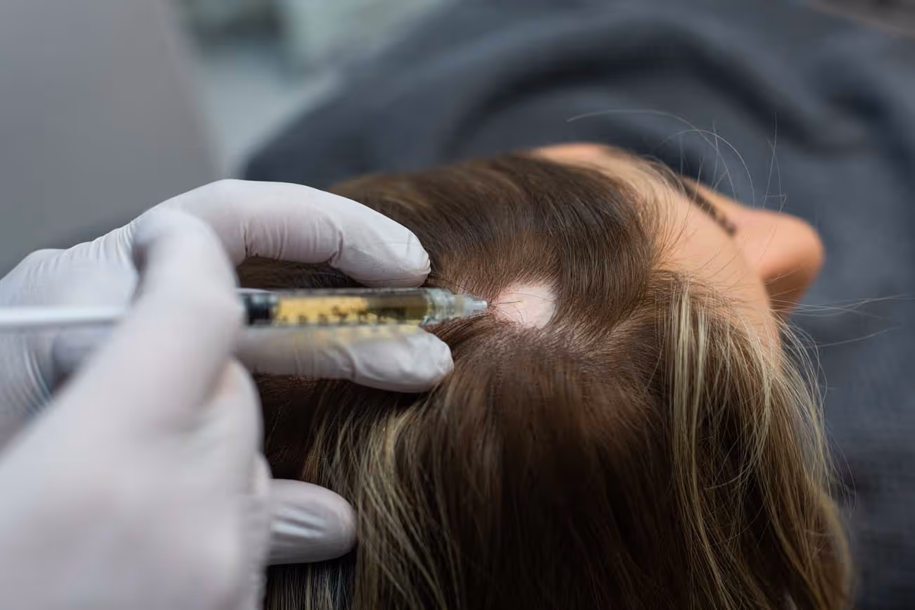 En kvinna med Alopecia areata får PRP-behandling
