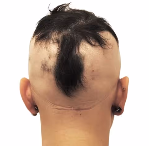 En kvinna med Alopecia universalis
