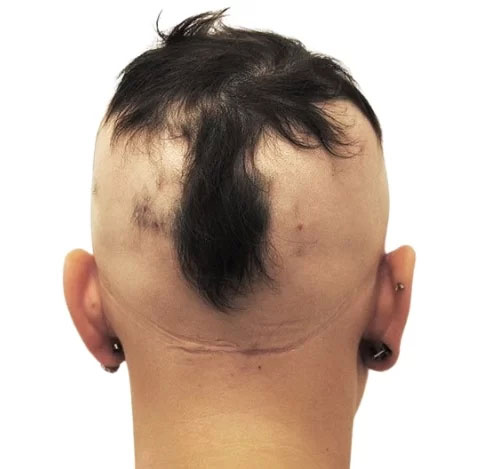 En kvinna med Alopecia universalis
